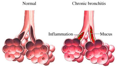 La bronchite peut provoquer des crachats avec du sang frais.